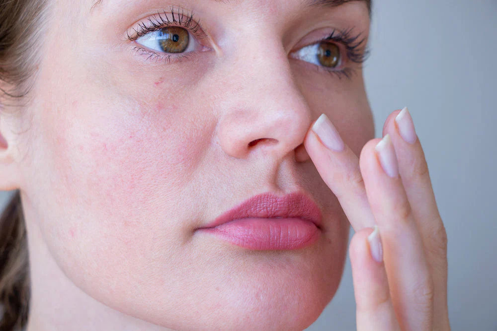Why Calming and Barrier Support Are Central to Rosacea‑Prone Skin